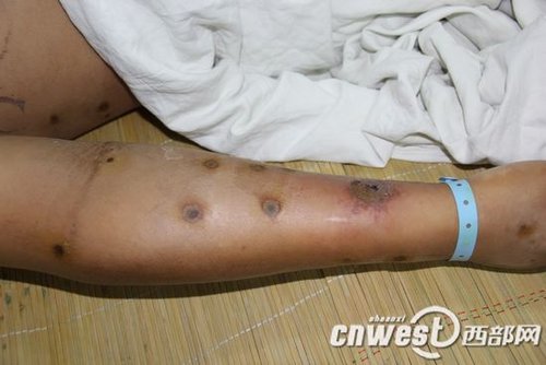 陕西安康频发毒蜂蜇人夺命事件已致21人死亡